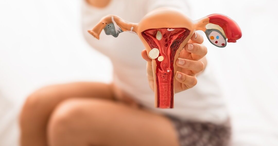 importancia del diagnostico precoz de endometriosis