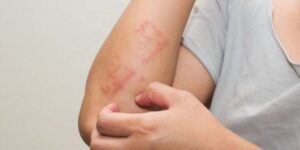 infecciones comunes en la piel