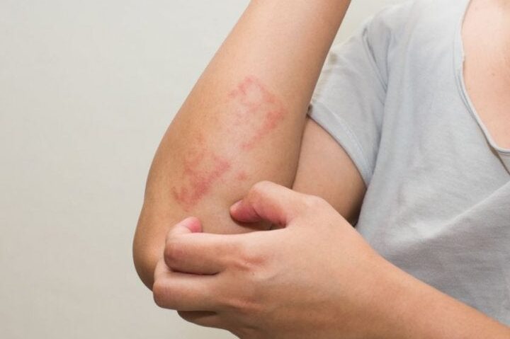 infecciones comunes en la piel