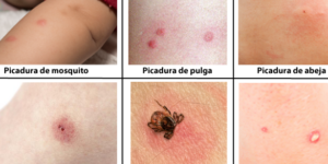 insectos que pican a ninos