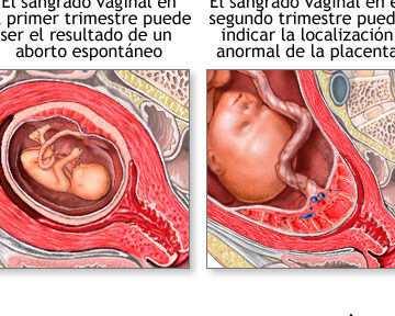 mujer embarazada con sangrado vaginal