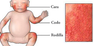 nino con eccema y cuidados