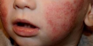 nino con psoriasis y bienestar