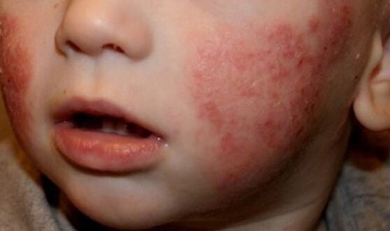 nino con psoriasis y bienestar