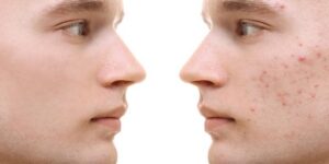 piel sana y prevencion del acne