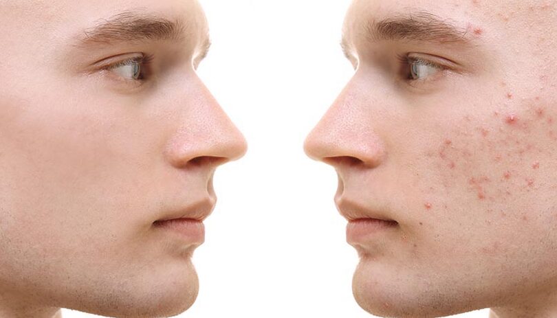 piel sana y prevencion del acne