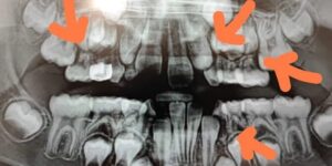 radiografias en odontologia pediatrica