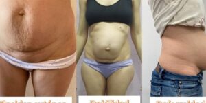 reconstruccion abdominal postparto