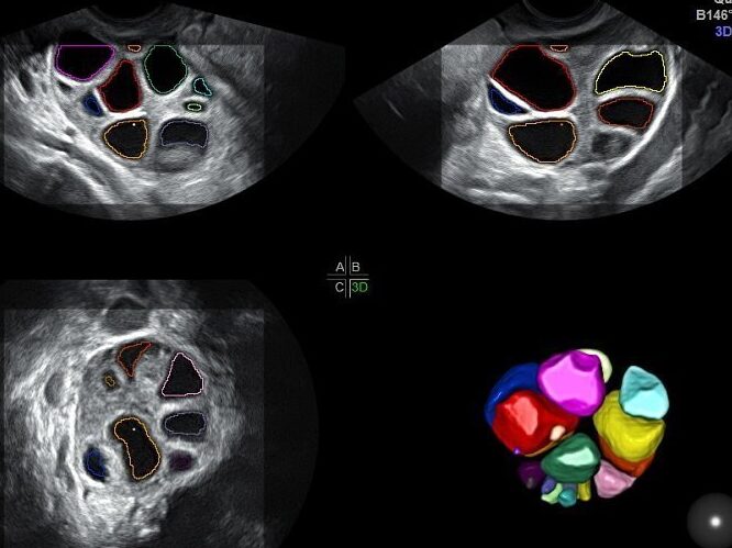 reserva ovarica y fertilidad cuidados