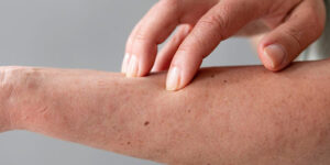 salud mental en la dermatitis atopica
