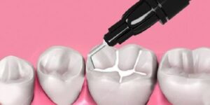 sellado de fisuras en dientes