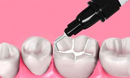 selladores dentales previenen caries dental