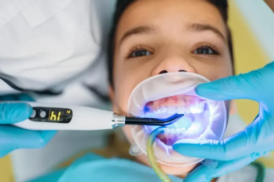 selladores dentales previenen caries infantiles