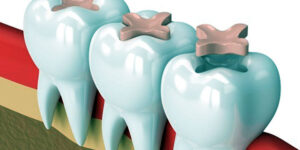 selladores dentales y su proteccion