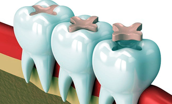 selladores dentales y su proteccion