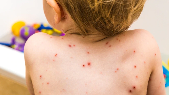 sintomas de alergias cutaneas en ninos