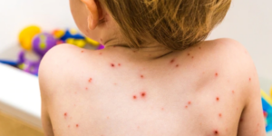 sintomas de alergias cutaneas en ninos