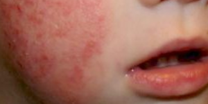 sintomas de dermatitis atopica en la infancia