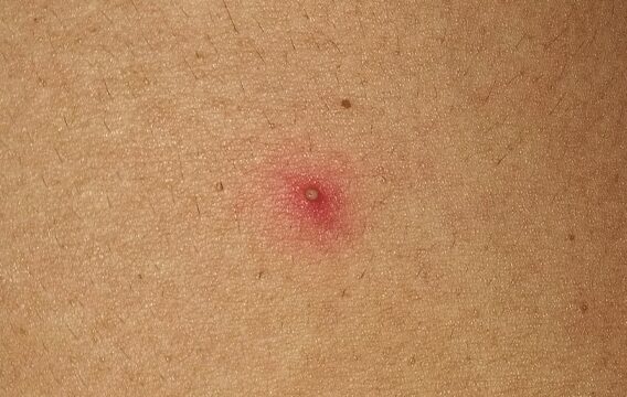 sintomas de foliculitis infantil y cuidados