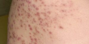 sintomas y causas de foliculitis