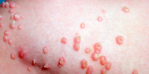 sintomas y tratamiento del molusco contagioso
