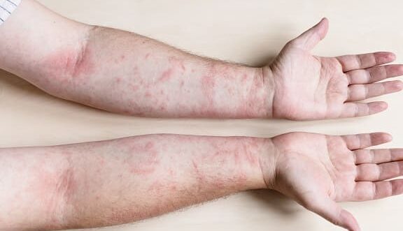 sintomas y tratamientos de dermatitis