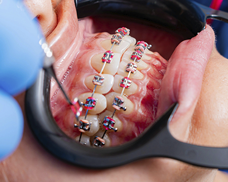 sonrisas saludables con ortodoncia para ninos