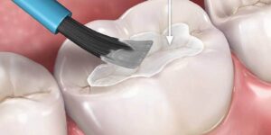 tecnica y recomendaciones para selladores dentales
