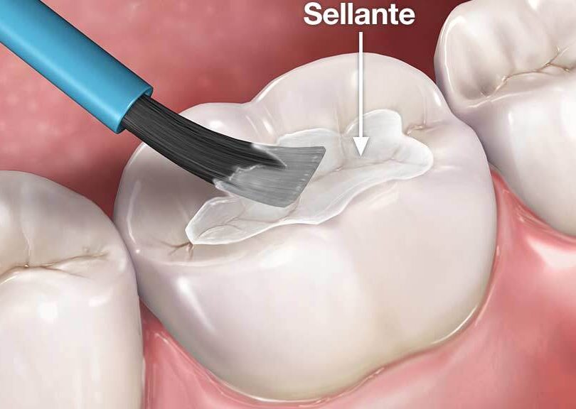tecnica y recomendaciones para selladores dentales
