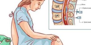 tipos de anestesia en cesarea
