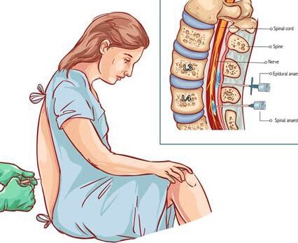 tipos de anestesia en cesarea