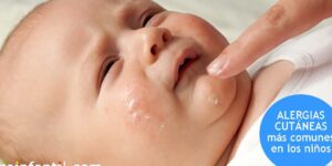 tratamiento de alergias cutaneas en ninos