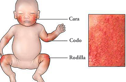 tratamiento efectivo para el eccema en ninos