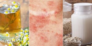 tratamientos naturales para la dermatitis