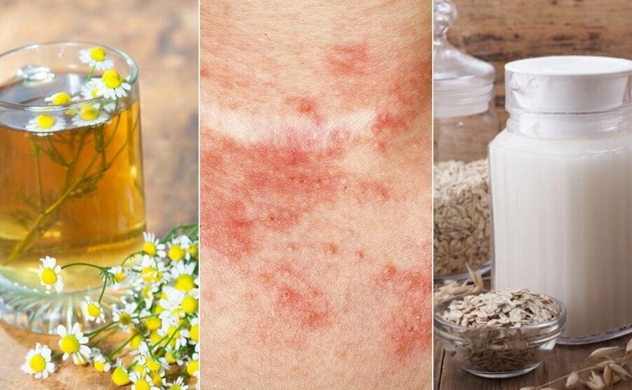 tratamientos naturales para la dermatitis