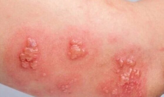 tratamientos para dermatitis y molusco contagioso