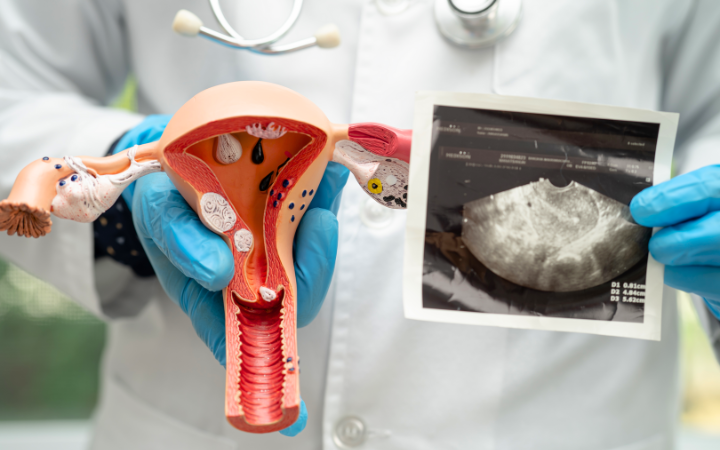 tratamientos para mejorar fertilidad en endometriosis