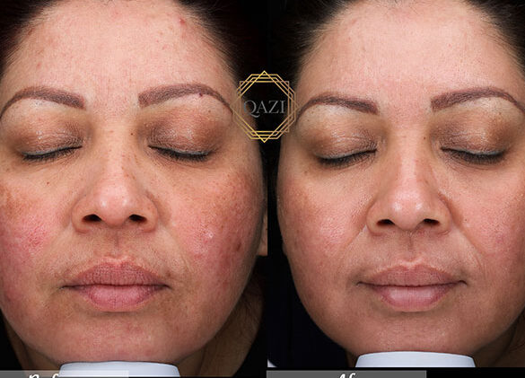 tratamientos recomendados para el acne