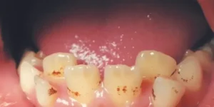 tratamientos restaurativos en dientes de leche