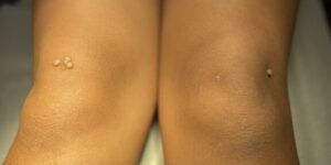 verrugas en codos y rodillas en ninos