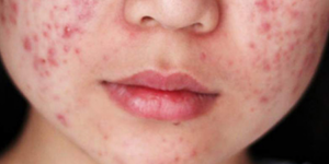 piel de ninos con acne