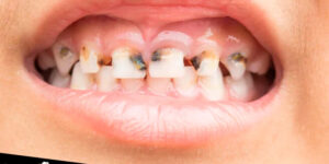prevencion de caries en dientes de leche