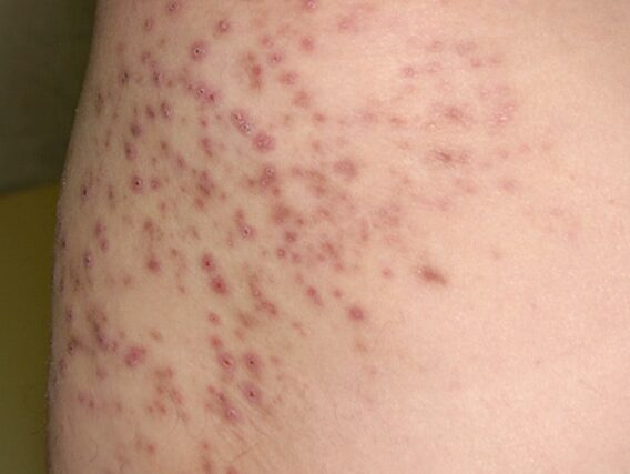 sintomas y tratamientos de foliculitis