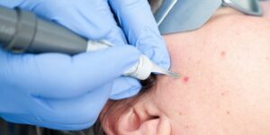 tratamientos laser para verrugas en ninos
