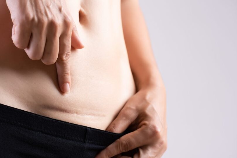 cuidados de cicatrizacion postparto