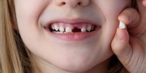 extraccion de dientes de leche