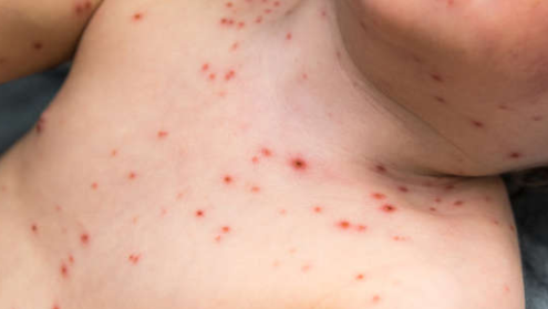 infecciones de la piel en ninos