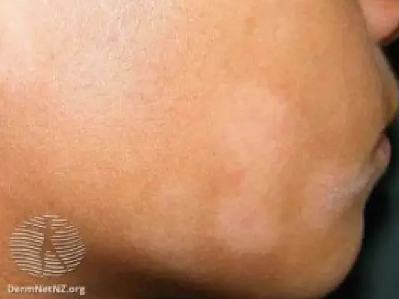 manchas en la piel de ninos