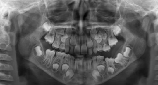 radiografias en odontologia pediatrica