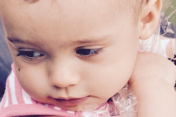 riesgos de lunares en infancia